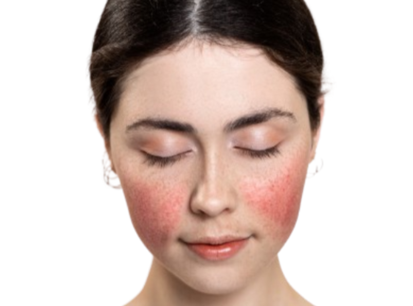 안면홍조증이란