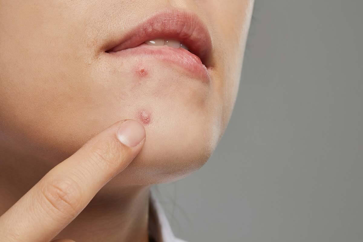 생리 전 증후군으로 인한 턱 여드름 발생 부위를 나타낸 이미지로 호르몬 변화와 피지선 밀집이 원인이며 적절한 피부 관리 방법으로 개선 가능