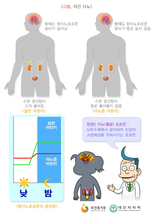 소아야뇨증