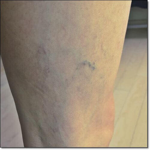 센시아 효능, 정맥과 림프 부전 개선