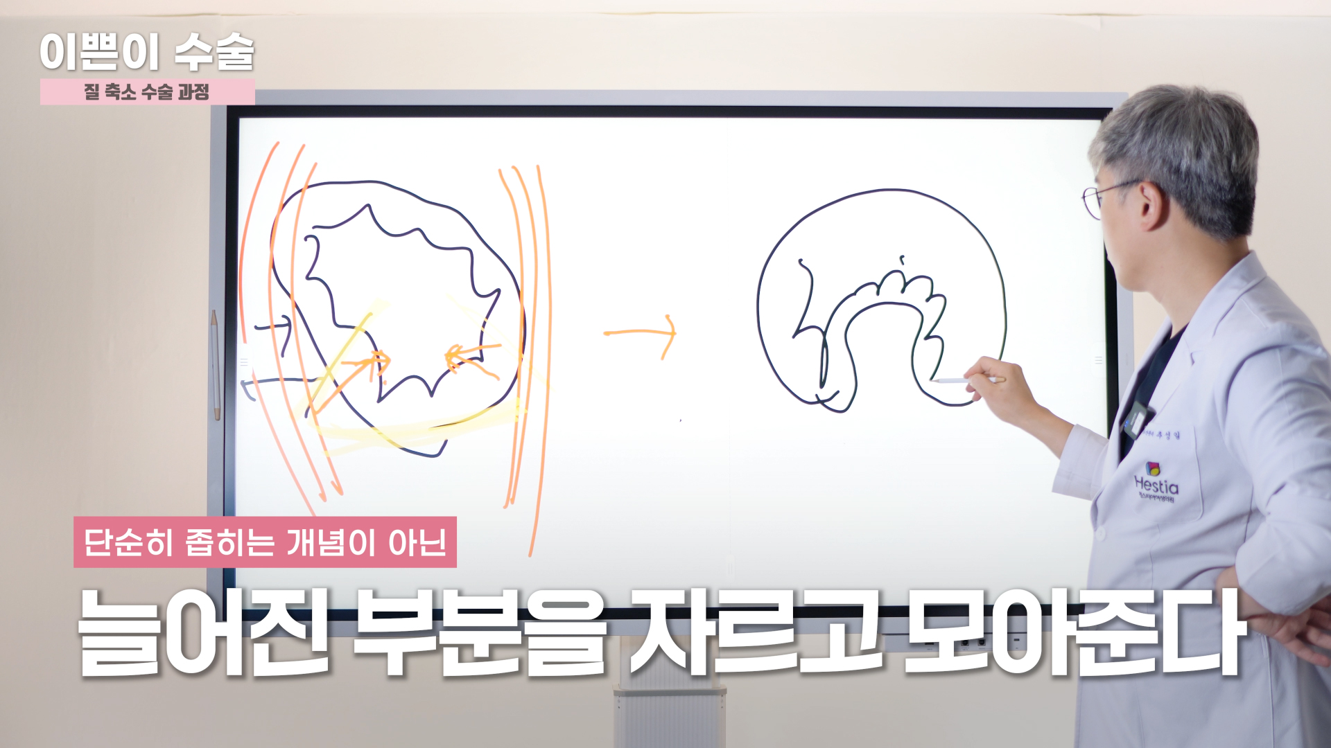 증상 심하면 질축소수술 꼭 필요한가요?