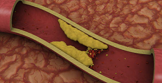 고지혈증에 좋은 음식 나쁜 음식 관리방법 파헤치기
