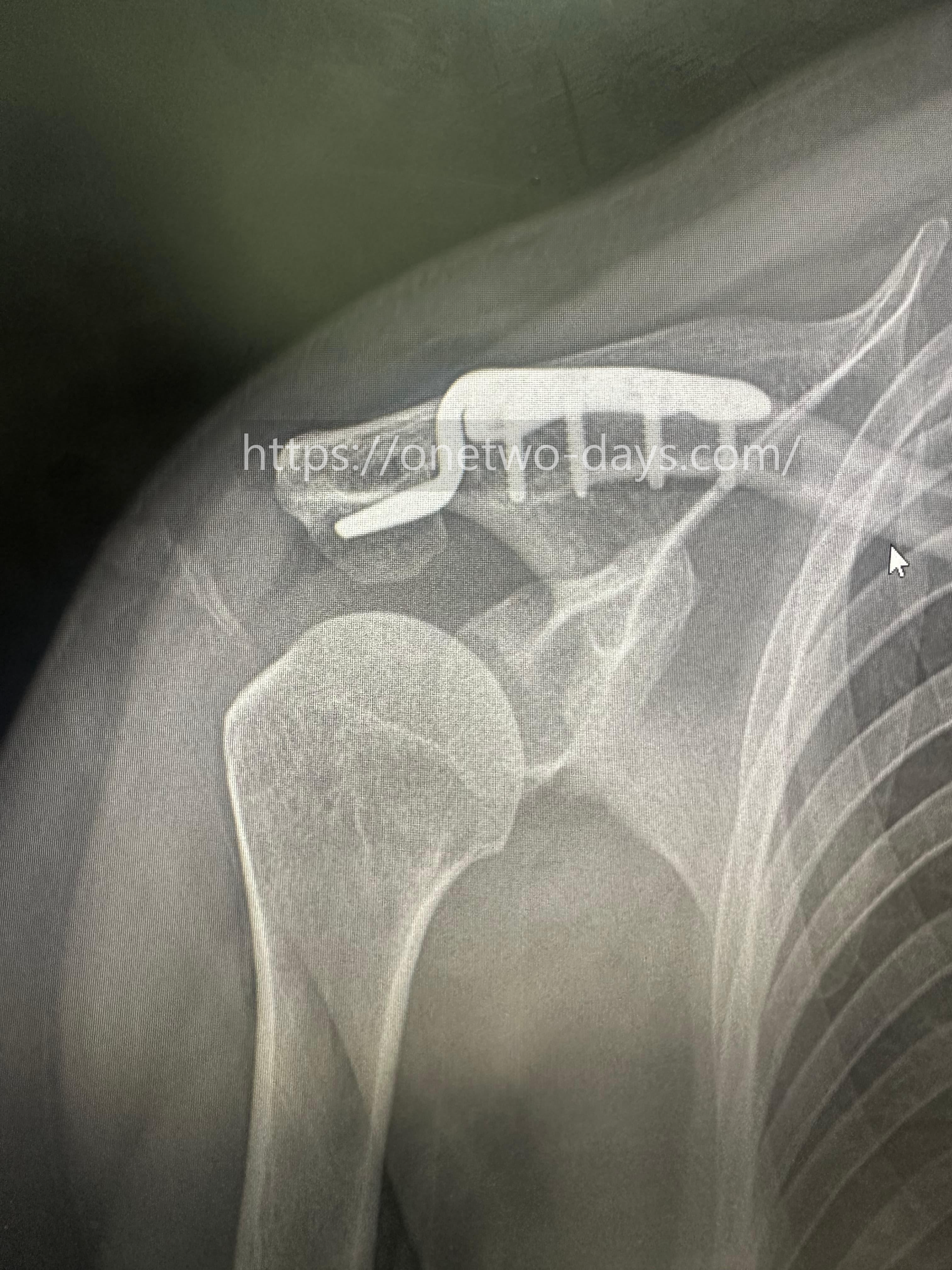 견쇄관절 탈구 후크플레이트 수술 정기검진 x-ray 사진 1