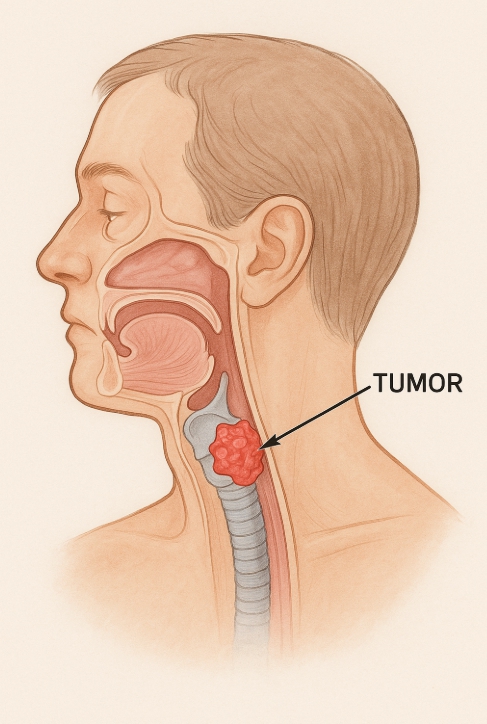 후두암 관련 자료 사진
