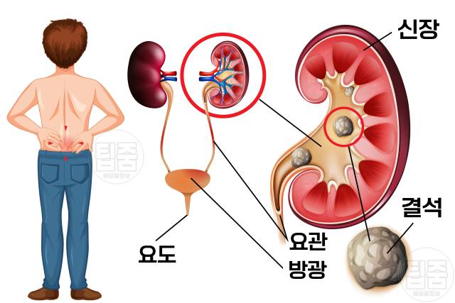 신장 나쁜 습관 신장에나쁜음식 수분섭취 부족 신장결석