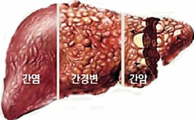 간질환 종류