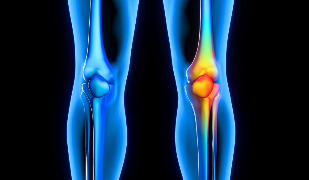 만성 통증을 나타내는 무릎 관절 X-ray 이미지, 정상 관절과 염증이 있는 관절 via canva