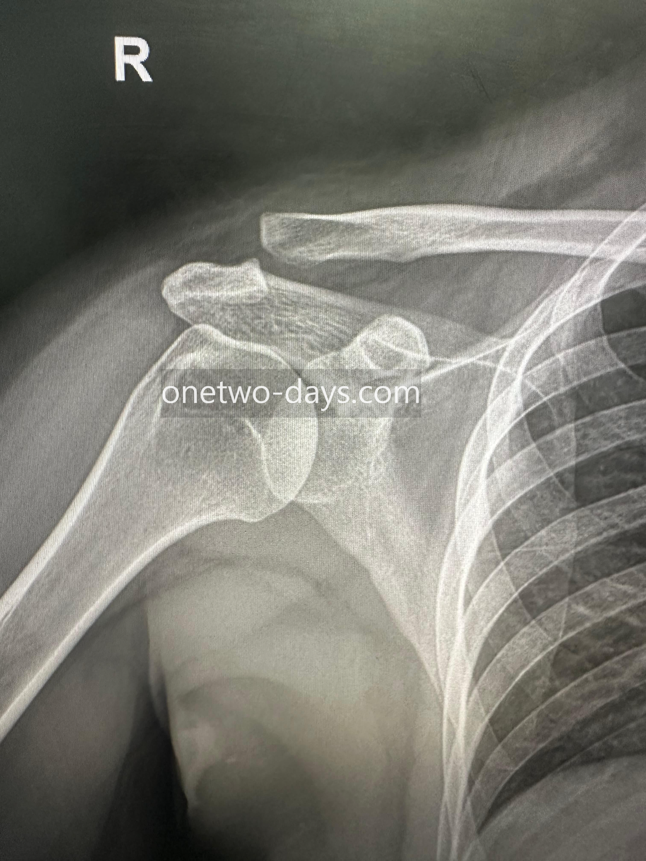 견쇄관절 탈구 수술 전 X-ray 실제 사진