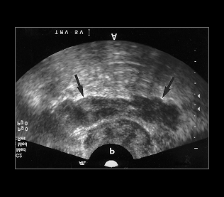 전립선 초음파검사