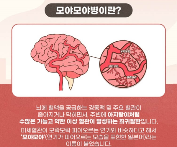 모야모야병-안내-이미지
