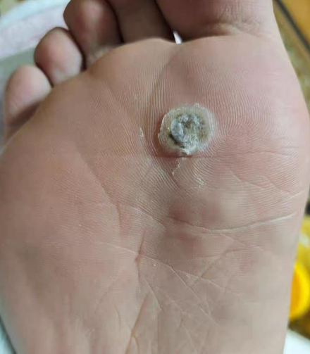 약국 티눈약으로 뿌리까지 제거하려면, 어떻게 해야할까?