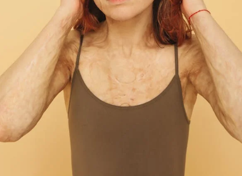 화상의 종류 및 응급처치