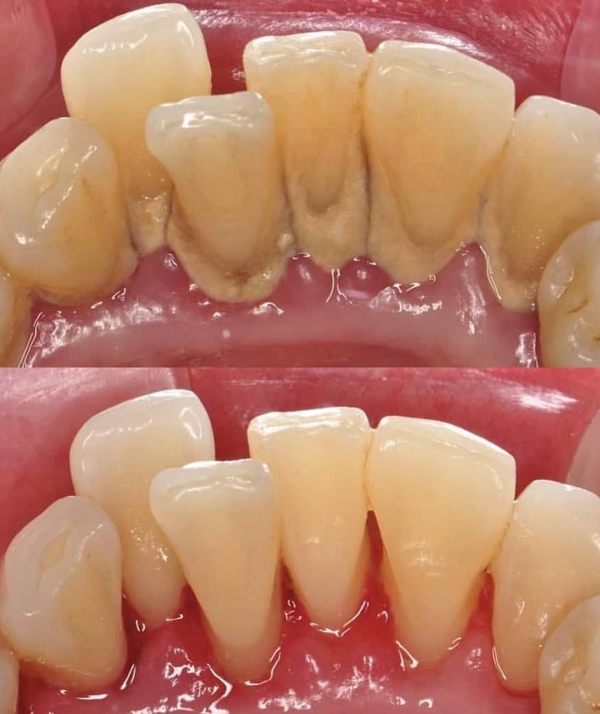 스케일링 하기전과 하고난 후
