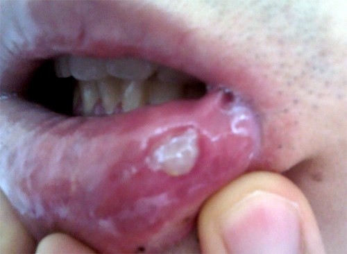 입술안쪽-구내염