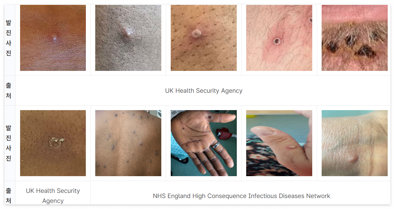 엠폭스 증상 원인 감염경로