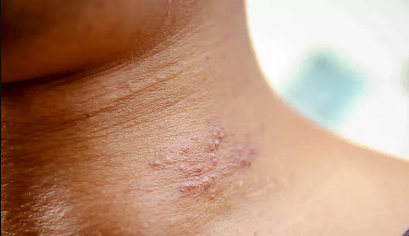 수포없는 대상포진