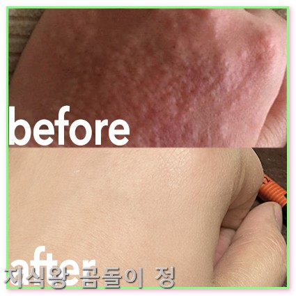 손등 좁쌀 두드러기 피부장벽 회복과 보습 꿀팁1