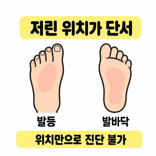 발등과 발바닥 그림을 나란히 배치하고 저린 위치는 단서이며 위치만으로 진단할 수 없다고 설명하는 이미지