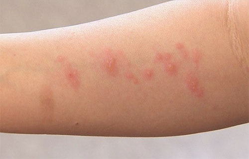 대상포진 초기증상