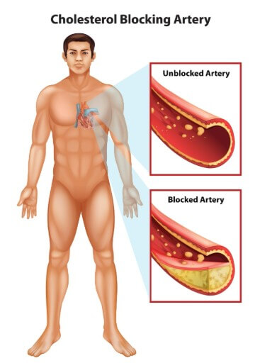 부정맥 원인인 혈관 찌꺼기 끼어 있는 모습
