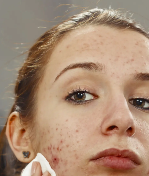 여드름 빠르게 없애는 법 여드름 치료 흉터 부위별 원인 좋은 음식