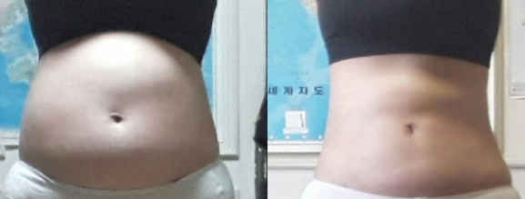 복부지방흡입 후기