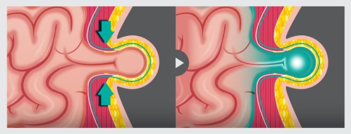 2. 탈장의 정의와 치료 필요성