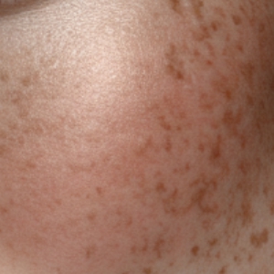 기미 완화 방법