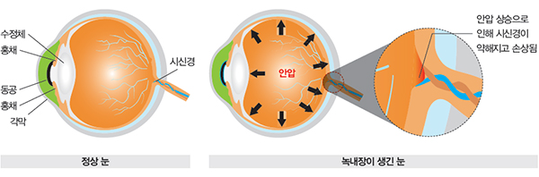 녹내장 생긴 눈