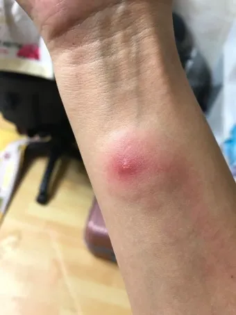 모기 물려 가려울 때 땀띠에 안티푸라민 연고 효능 부작용 사용후기_11