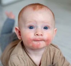 아토피에 안좋은 음식들