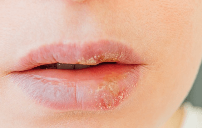 입술물집(헤르페스 1형)