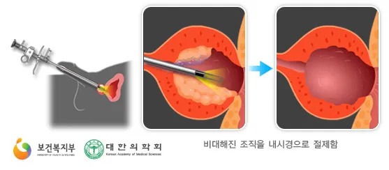 전립선비대증 치료