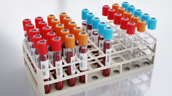 낮은 고밀도 콜레스테롤