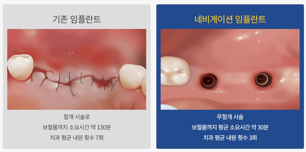 네비게이션 임플란트