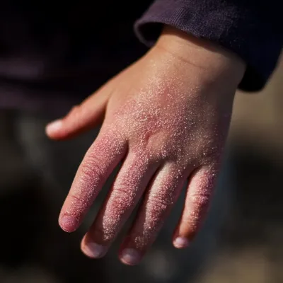 아기 수족구 증상 총정리! 부모가 꼭 알아야 할 팁_4