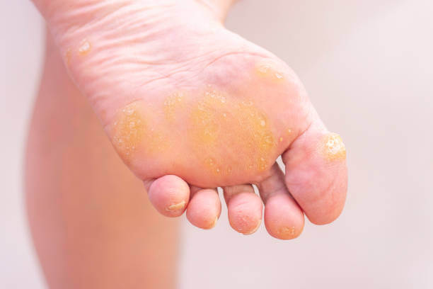 티눈 생기는 이유, 굳은살과 사마귀 차이 및 치료에 대해 알아봤습니다. 한번쯤은 손과 발에 티눈이 발생하는 것을 볼 수 있습니다. 티눈이 생기는 이유와 굳은살, 사마귀 차이점, 치료법, 티눈약 부작용 및 주의사항도 참고하시기 바랍니다.