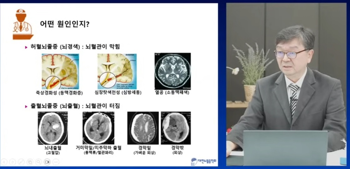 EBS-명의-경동맥-방오영-교수-뇌졸중