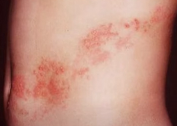 대상포진 예방접종