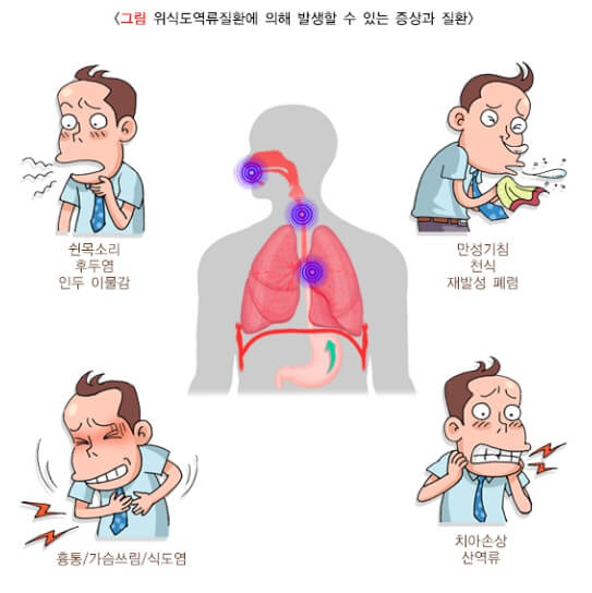 역류성 식도염 증상