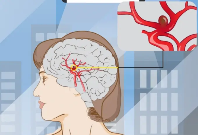 뇌동맥류 증상
