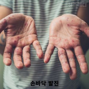 수족구 증상