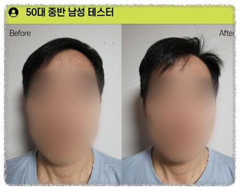 탈모 샴푸 판매1위 그래비티 탈모 개선 이미지