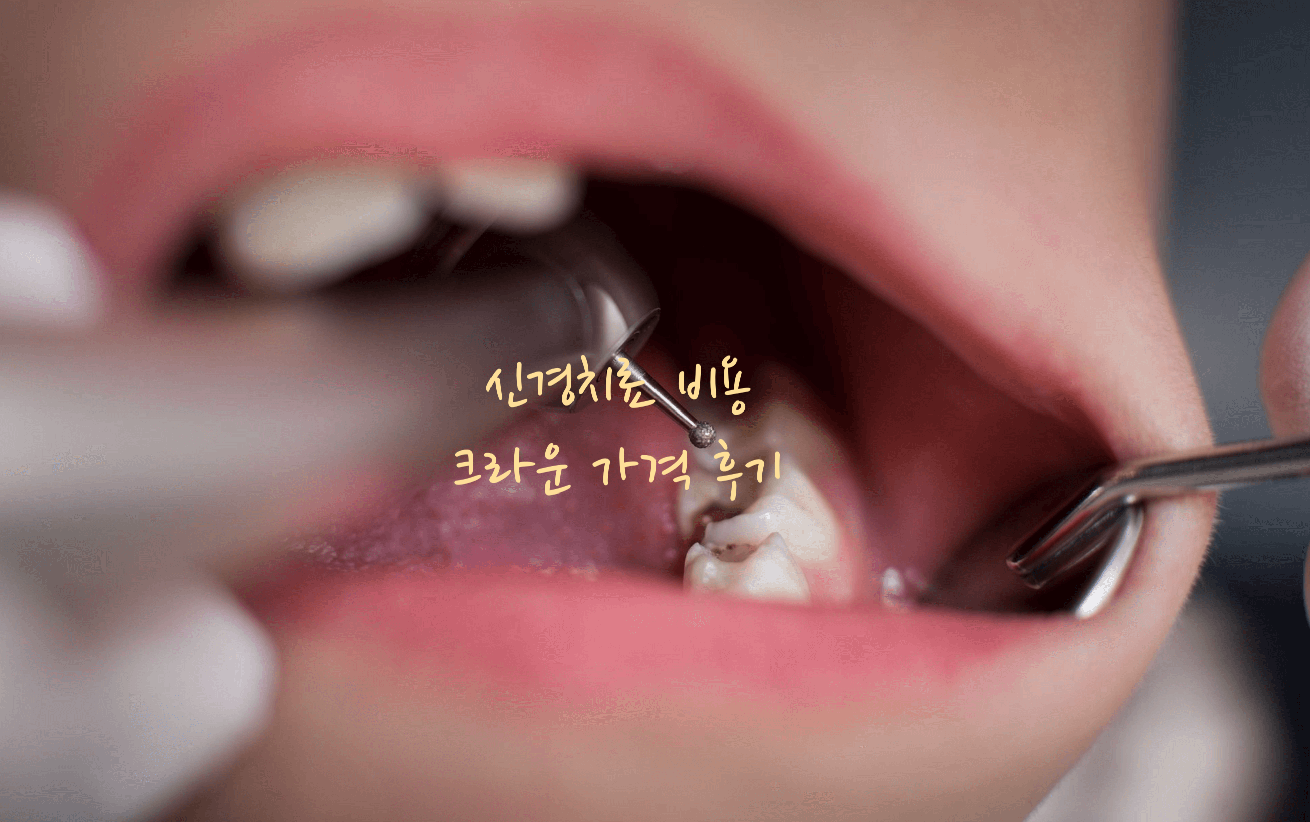신경치료 비용