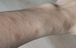 햇빛 알러지, 햇빛 두드러기, 열두통, 더위 두통, 광선과민증, 여름 피부트러블, 콜린성 두드러기, 일사병, 열사병, 자외선 질환