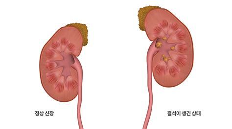 요로 결석 보험