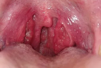 침 삼킬때 목아픔 코로나 증상인지 감별법_9