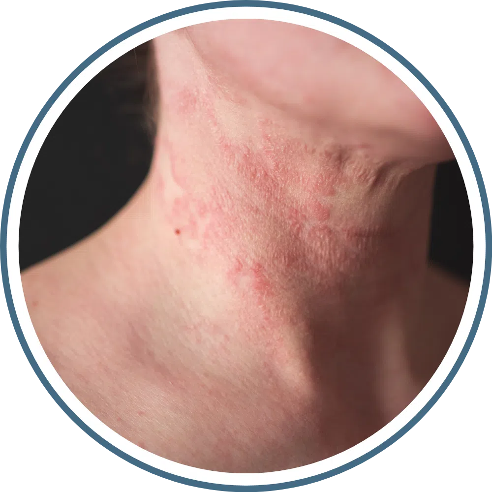 아토피는 타고나는 게 아니라&amp;#44; 관리로 악화됩니다!