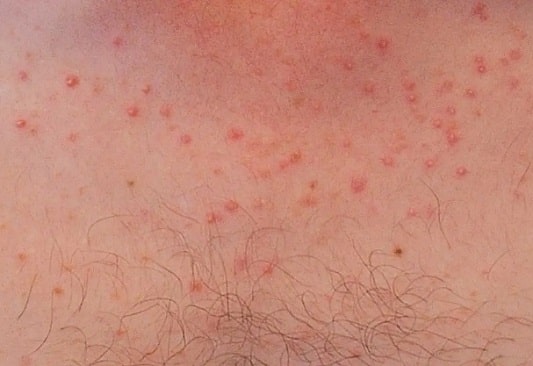 포도상구균 감염