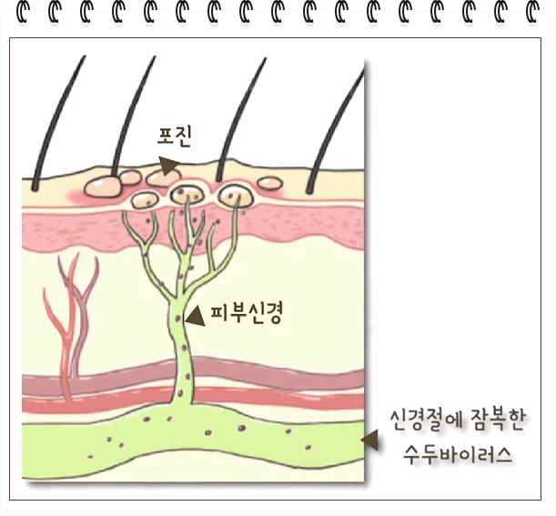 대상포진에 좋은 음식 신경절에 잠복한 수두바이러스